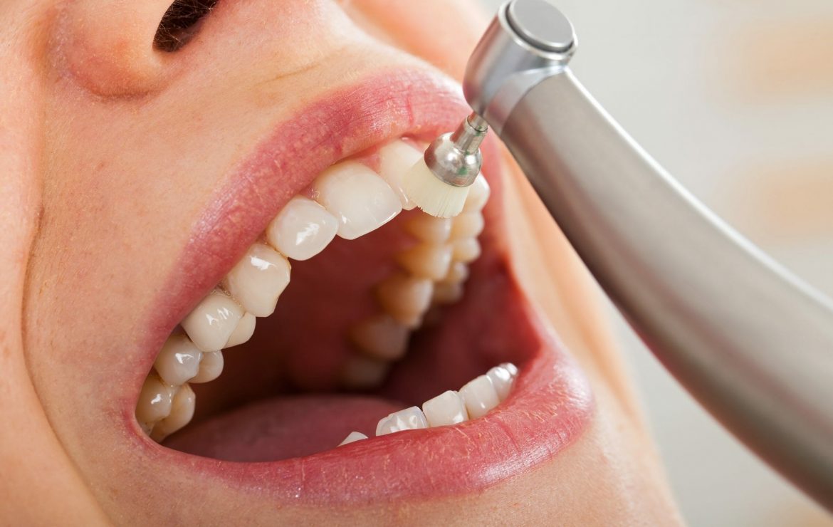 Why Deep Periodontal Cleanings in Buffalo Grove are Worth the Investment in Your Smile?