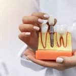 Dental Implants