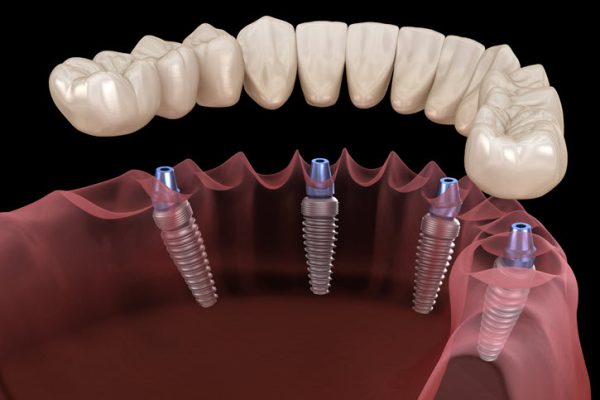 Dental Implants