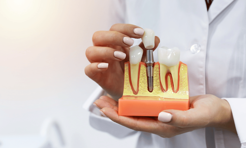 Dental Implants