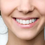 Smile Makeover