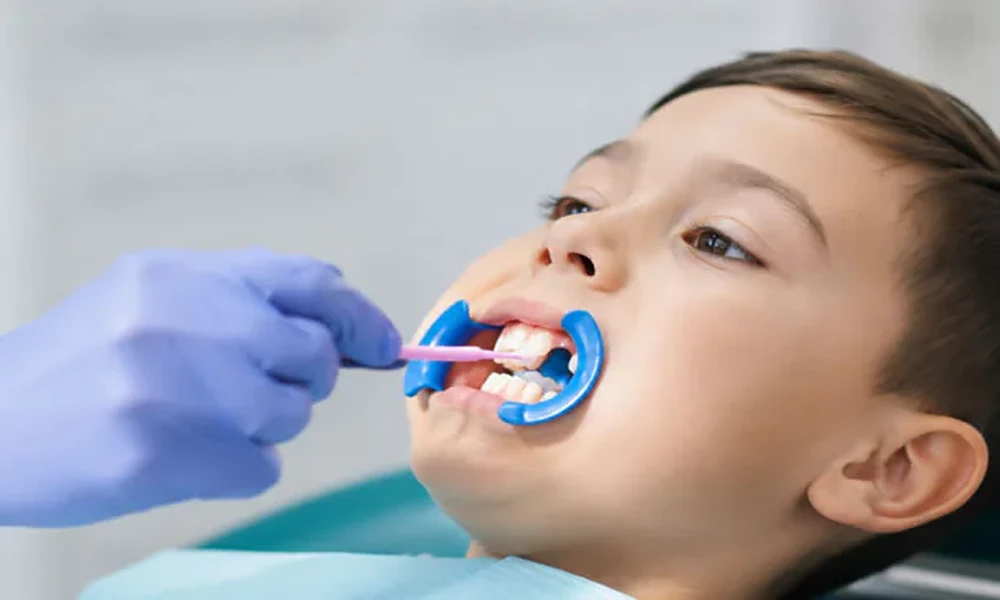 Preventive Sealants: A Smart Start For Cavity Prone Kids